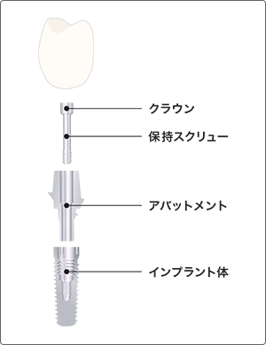 インプラント器具